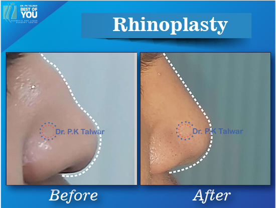 rhinoplasty surgery result